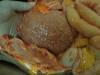 cirhosis of liver